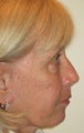 Upper and lower lid blepharoplasty, chemical peel to lower lids