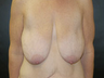 Breast Lift