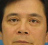 Blepharoplasty, Eyelid Surgery