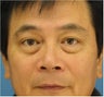 Blepharoplasty, Eyelid Surgery