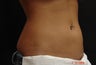 Coolsculpting