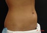 Coolsculpting