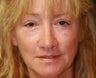 Lip Lift and Eyelid Rejuvenation