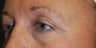 She didn't like the aging of her lower lids