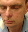 Male Patient Treated with Sculptra