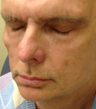 Male Patient Treated with Sculptra