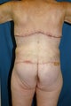 body lift and back lift in a bariatric patient
