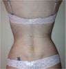 Laser Liposuction
