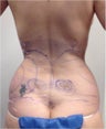 Laser Liposuction