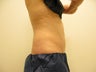 57 year old female treated for excess abdominal fat