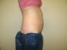 57 year old female treated for excess abdominal fat