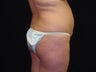 Brazilian Buttocks Lift