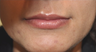 Beautiful Lips with soft Silicone implants
