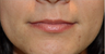 Beautiful Lips with soft Silicone implants