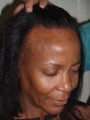 DIFF ANGLES Hairline Advancement