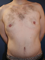 Male Tummy Tuck