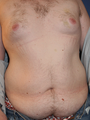 Male Tummy Tuck