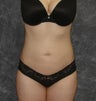 Liposuction