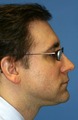 Chin/Neck Liposuction