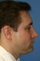 Chin/Neck Liposuction