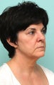 Broadband light (BBL), MicroLaserPeel, Profractional Resurfacing, Dermal Filler - Radiesse in cheeks