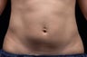 Liposonix