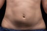 Liposonix