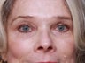 Brow Lift