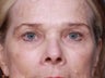 Brow Lift