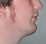 26 Year Old Male Treated For Small Chin and Lack of Neckline