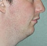 26 Year Old Male Treated For Small Chin and Lack of Neckline