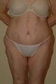 Body lift
