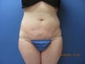 Liposuction of Abdomen and Waist