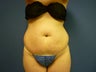 Liposuction of Abdomen and Waist