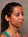 Chin Implant