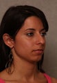 Chin Implant
