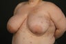 Breast Reconstruction