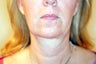 50 Year Old Female treated with Ultherapy for sagging Neck