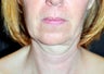 50 Year Old Female treated with Ultherapy for sagging Neck