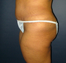 Butt Augmentation