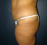 Butt Augmentation