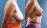 43 Year-Old Female Treated with Breast Reduction for Excessive Breast Size