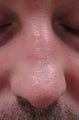 Male Treated for Scars post Mohs Surgery