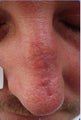 Male Treated for Scars post Mohs Surgery