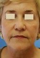 Artefill for NasoLabial Folds