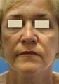 Artefill for NasoLabial Folds