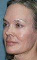 Female Patient Treated with Fraxel Repair