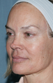 Female Patient Treated with Fraxel Repair
