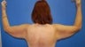 Armlift