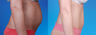Mini Tummy Tuck with Diastasis Repair